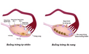 Buồng trứng đa năng