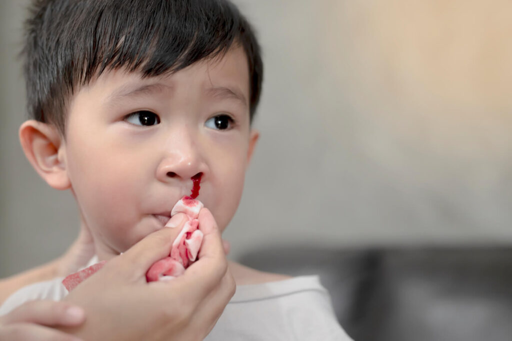 Chảy máu mũi trước thường gặp ở trẻ em 