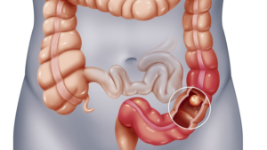 Chẩn đoán phân biệt giúp làm rõ sự khác nhau giữa đau ruột thừa và căn bệnh khác