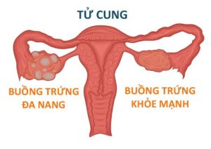 Đa nang buồng trứng là gì?