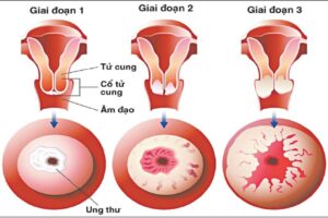 Dấu hiệu ung thư cổ tử cung