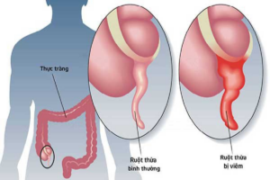 Tổng quan về tình trạng đau ruột thừa