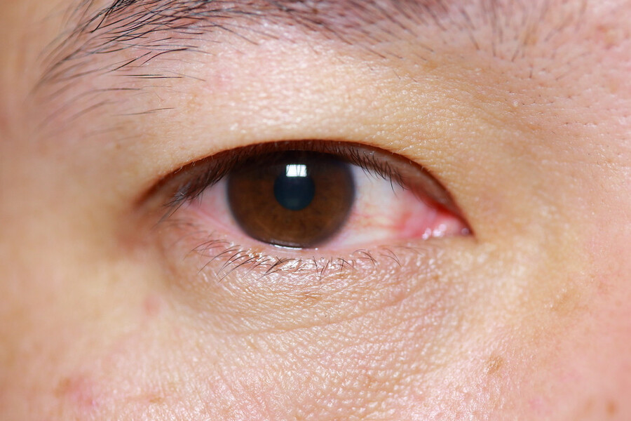 Đau mắt đỏ là tình trạng viêm lớp lót màng trong mí mắt và nhãn cầu. Lớp lót màng này được gọi là kết mạc. 