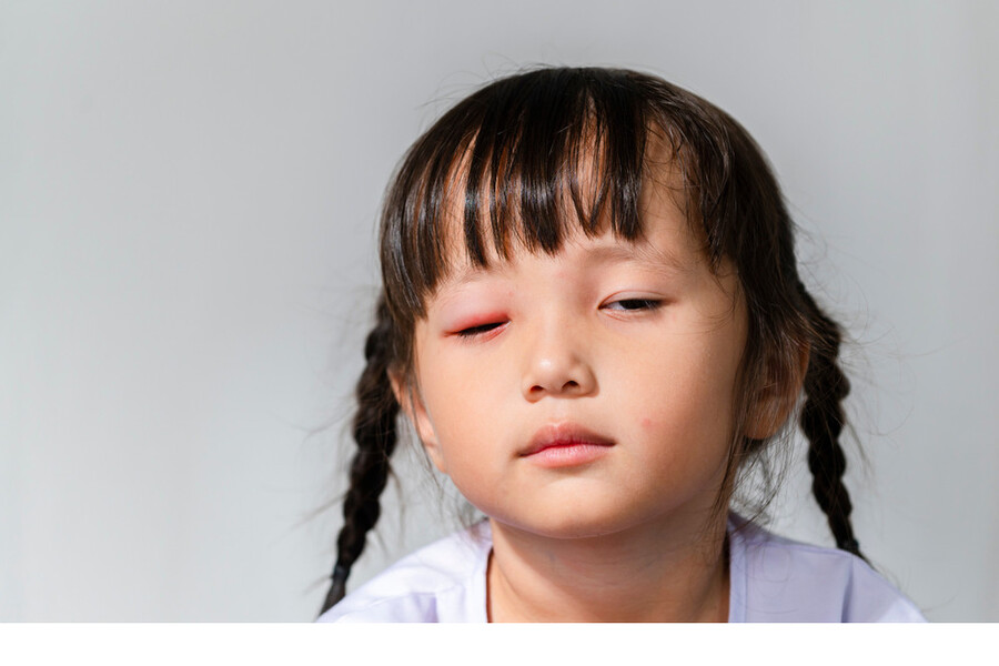 Các triệu chứng đau mắt đỏ thường bao gồm đỏ, ngứa hay khó chịu ở một hoặc hai mắt.