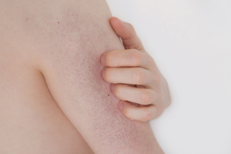 Dày sừng nang lông là tình trạng da xuất hiện các mảng khô, thô ráp và các vết sưng tấy ở cánh tay trên, đùi, má hoặc mông và không gây ra cảm giác đau, ngứa.