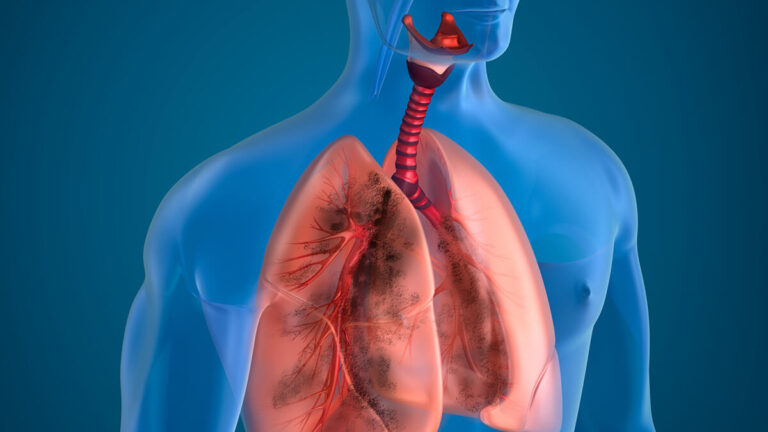 Đối tượng cần chụp CT phổi