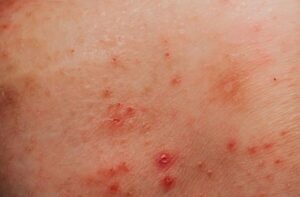 Mụn rộp sinh dục là  bệnh lây truyền qua đường tình dục do virus herpes simplex (HSV) gây, lây lan qua tiếp xúc da kề da trong hoạt động tình dục.