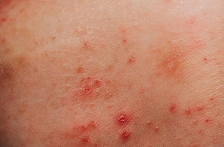 Mụn rộp sinh dục là  bệnh lây truyền qua đường tình dục do virus herpes simplex (HSV) gây, lây lan qua tiếp xúc da kề da trong hoạt động tình dục.