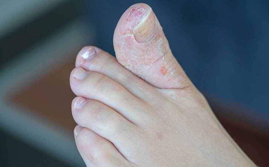 Bệnh nấm da chân dễ tái phát và nặng hơn nếu không điều trị đúng cách.
