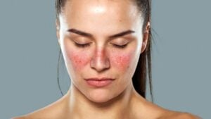 Bệnh nhân có thể tăng nguy cơ mắc lupus do nội tiết tố