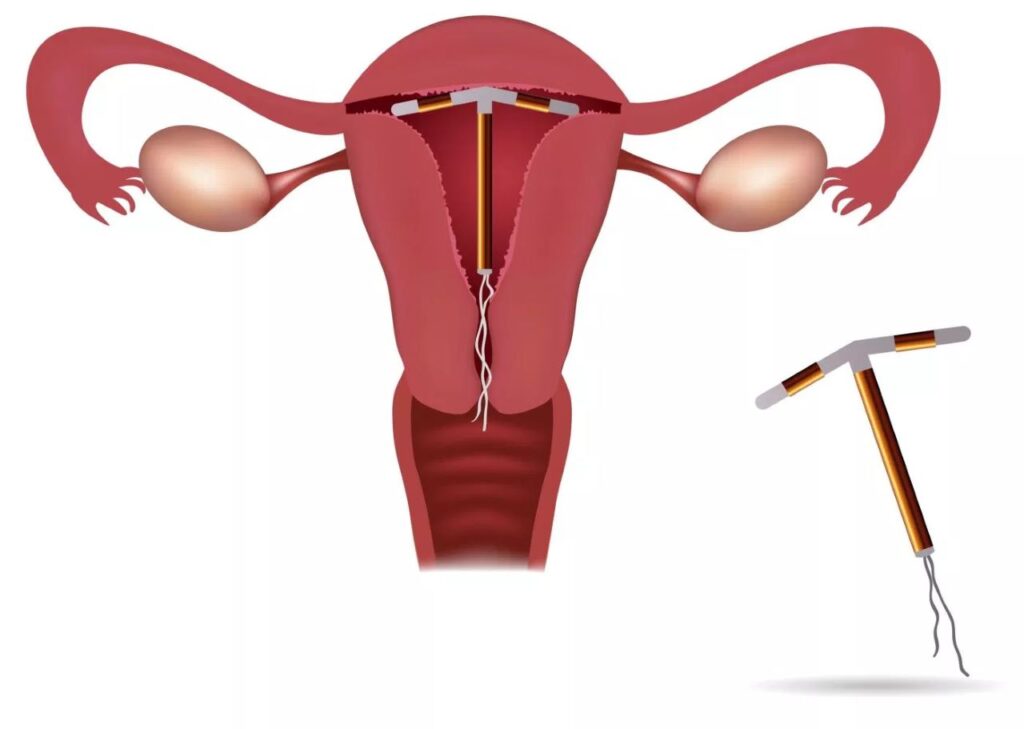 Rong kinh là tác dụng phụ thường gặp của vòng tránh thai 