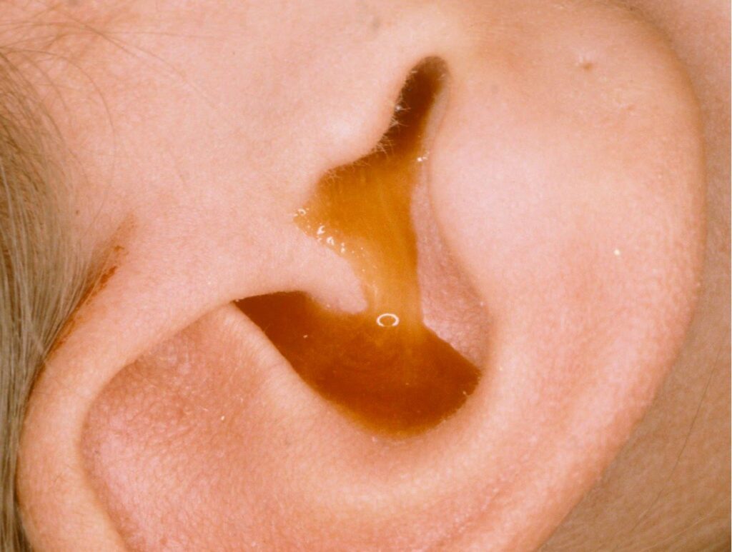 Viêm tai mãn tính gây chảy dịch mủ ra ống tai 