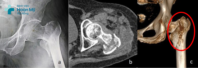 Hình ảnh gãy liên mấu chuyển xương đùi trái phức tạp trước phẫu thuật của người bệnh