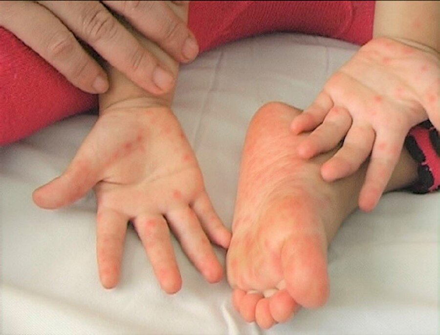 Nguyên nhân phổ biến nhất của bệnh tay chân miệng là nhiễm vi-rút coxsackievirus 16.