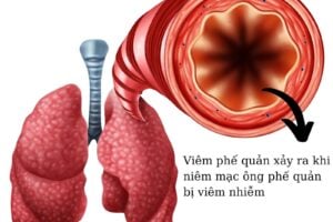 Triệu chứng của bệnh viêm phế quản