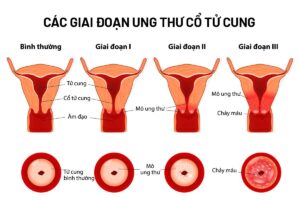 Ung thư cổ tử cung là gì?