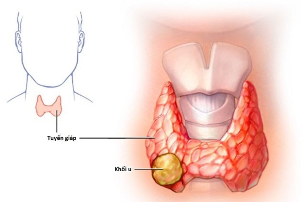 Ung thư tuyến giáp