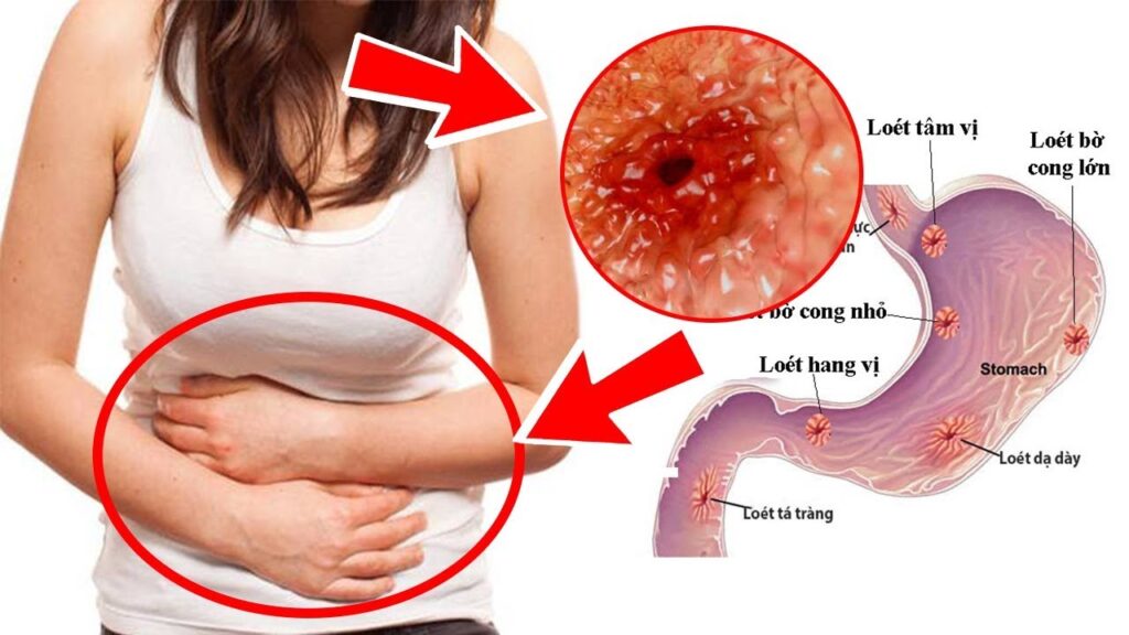 Viêm loét dạ dày gây ra nhiều cơn đau thắt  ở vùng bụng dưới bên trái 