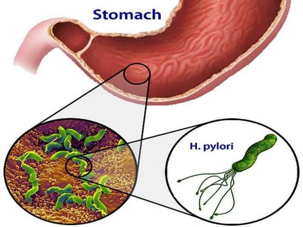 Vi khuẩn HP là một trong các nguyên nhân gây viêm loét dạ dày