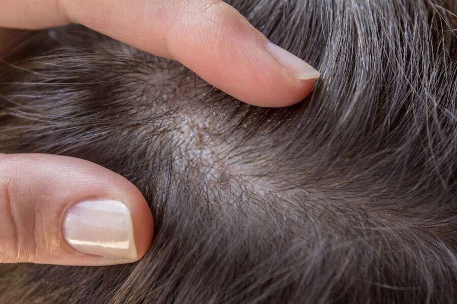 Viêm nang lông xuất hiện ở đầu có thể gây ra nhiều biến chứng khó lường liên quan tới da đầu.