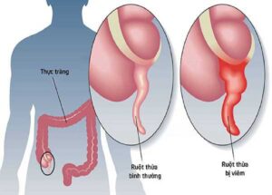 Tình trạng ruột thừa bị viêm