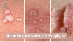 Sùi mào gà do virus HPV gây ra