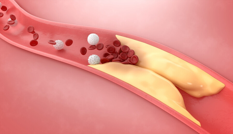 Xơ vữa động mạch là sự tích tụ chất béo, cholesterol và các chất khác trong và trên thành động mạch.