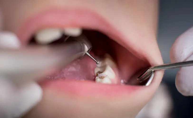 Vệ sinh răng miệng kỹ lưỡng là điều cần thiết để ngăn ngừa sâu răng.