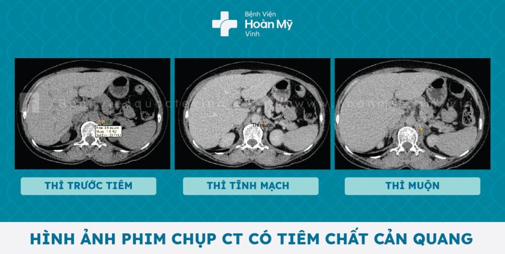 Đề phòng triệu chứng hạ Kali máu – Dấu hiệu cảnh báo u tuyến thượng thận