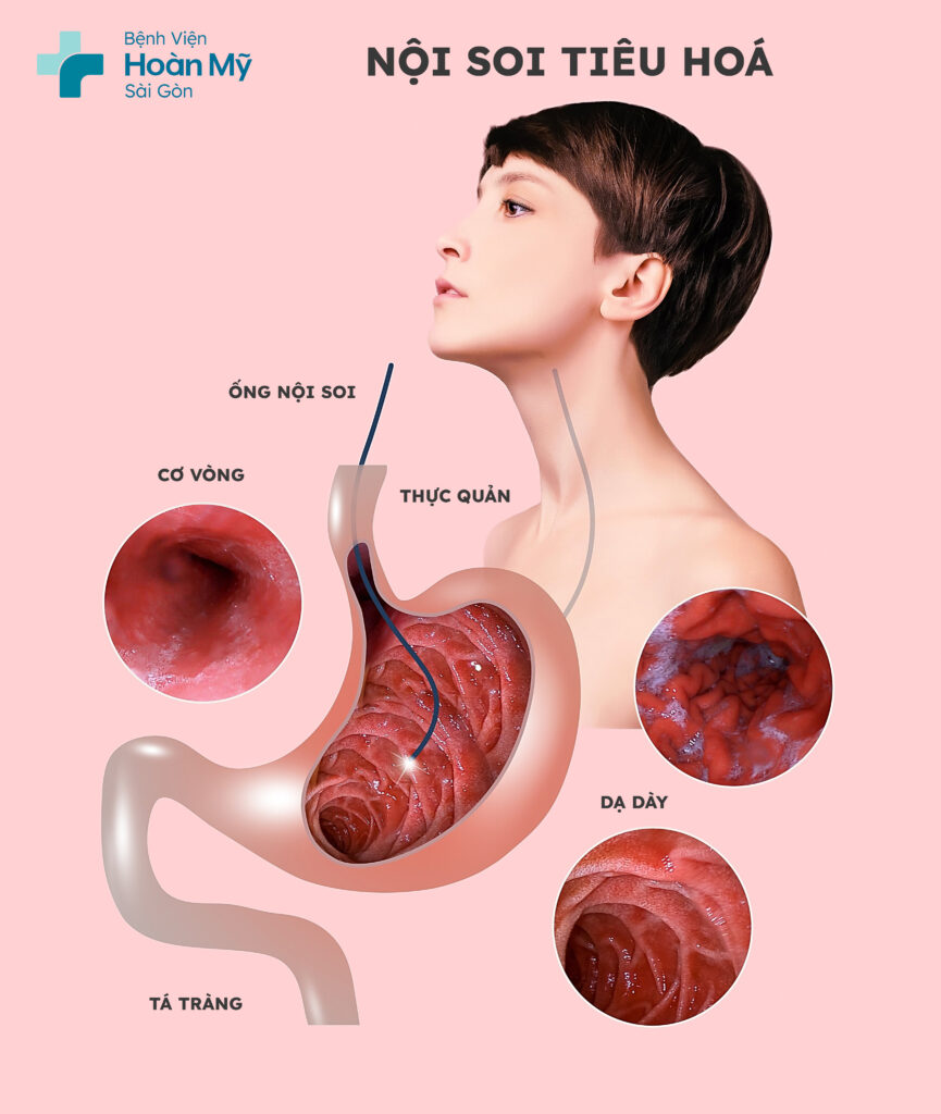 Nội soi ống mềm phát hiện sớm ung thư dạ dày tăng tỷ lệ điều trị thành công