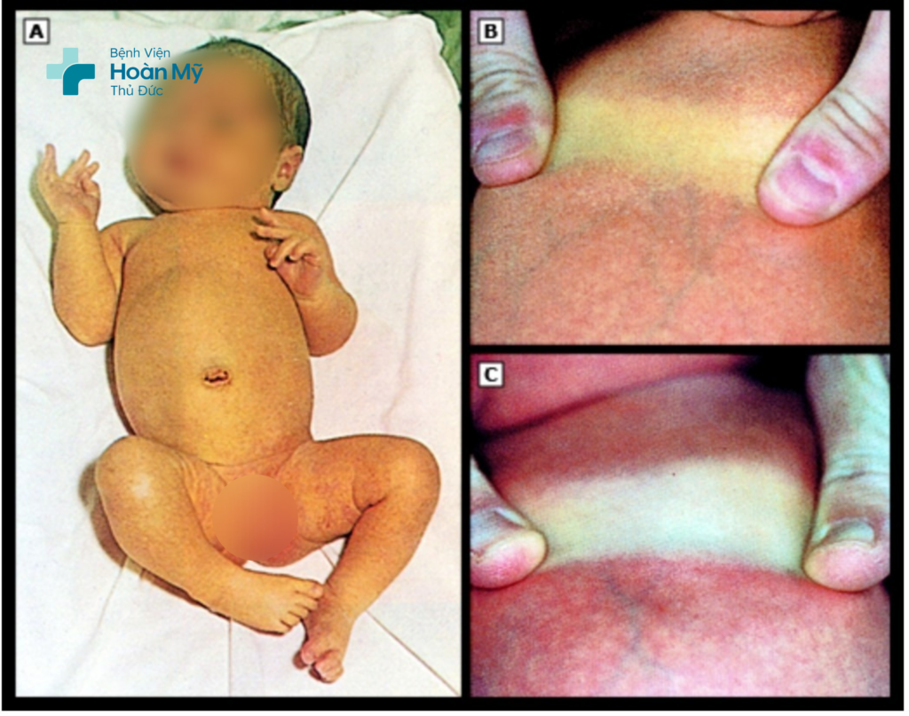 Bệnh vàng da ở trẻ sơ sinh