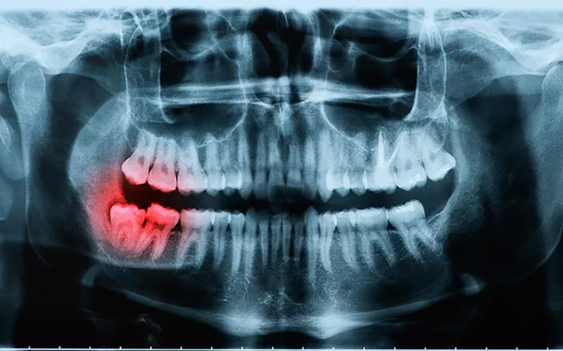 Nha sĩ sử dụng máy X quang để kiểm lỗ sâu trên răng 