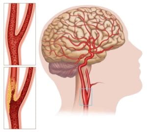 Biến động mạch cảnh