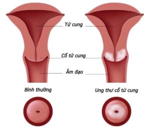 Khi hư bã đậu cũng là dấu hiệu của ung thư cổ tử cung