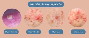 Các loại mụn viêm