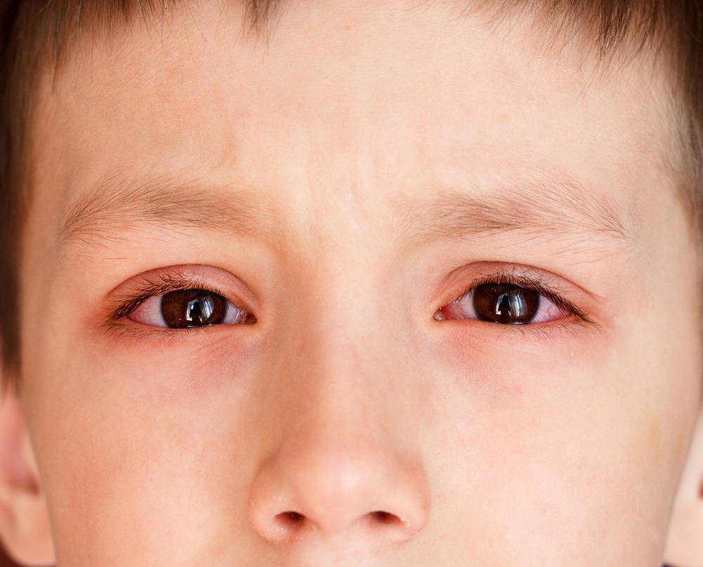 Đau mắt có thể đi kèm thêm các triệu chứng khô, ngứa, đỏ mắt 
