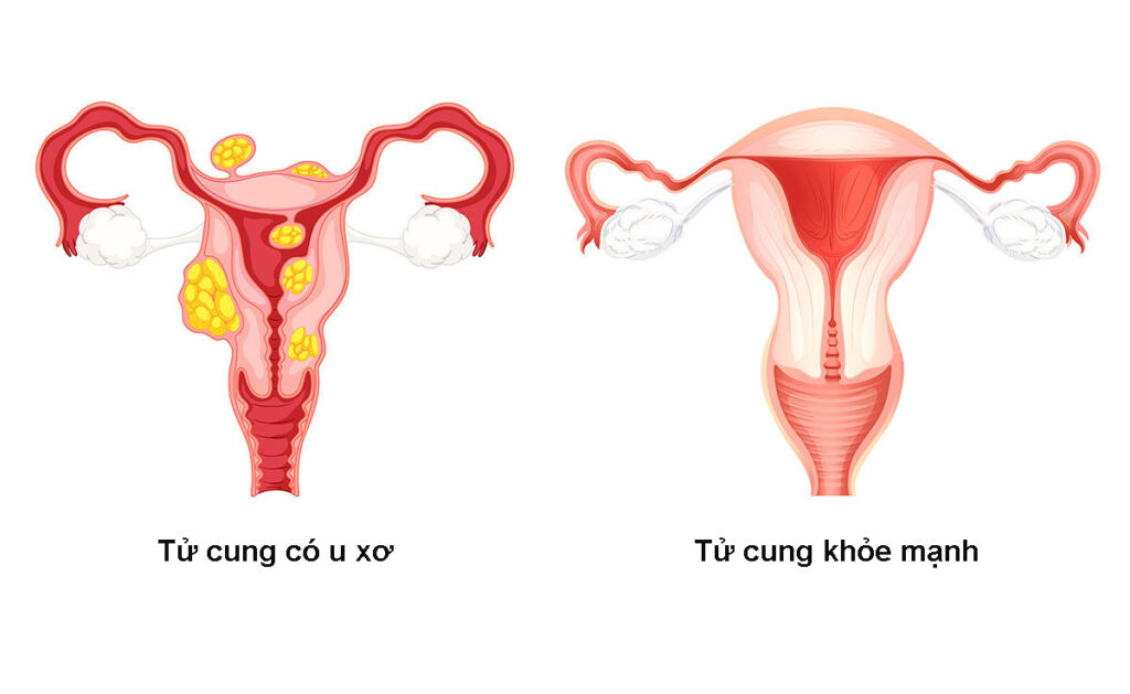 Cấu tạo tử cung không bình thường 