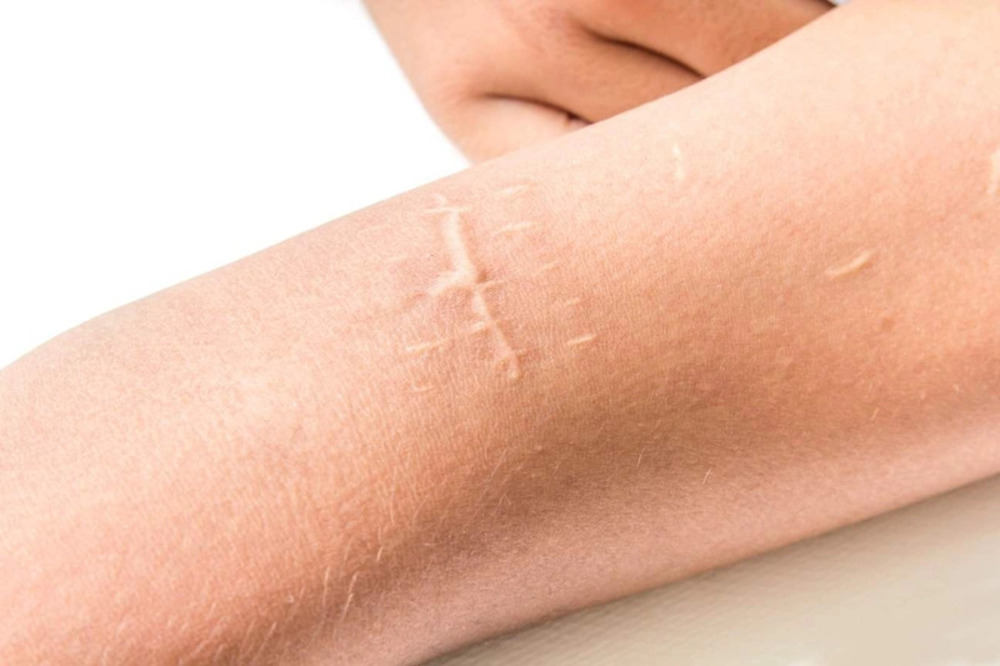 Contractubex là thuốc điều trị và làm mờ các vết sẹo trên da