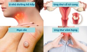 Một số dấu hiệu nhận biết nhiễm virus HPV