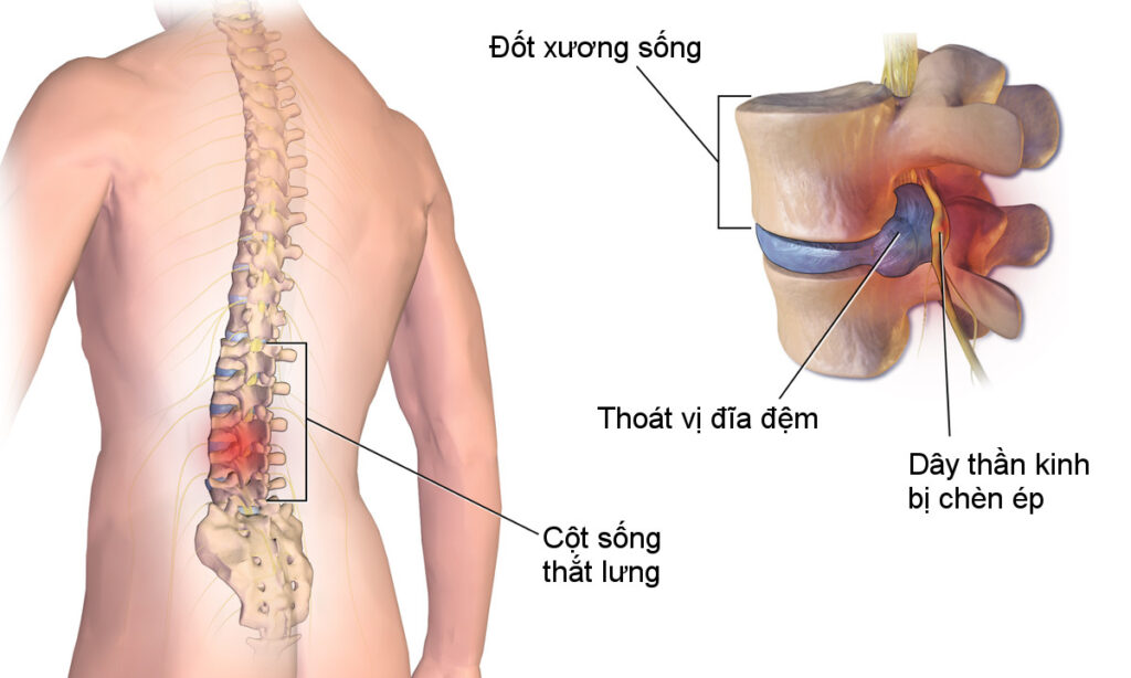 Thoát vị đĩa đệm là nguyên nhân gây ra triệu chứng đau lưng dưới 