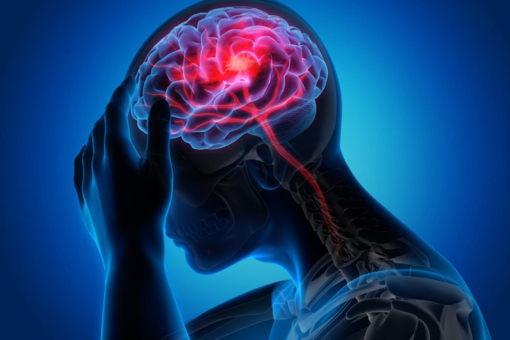 Đau đầu Migraine còn được biết đến với tên gọi là đau đầu vận mạch