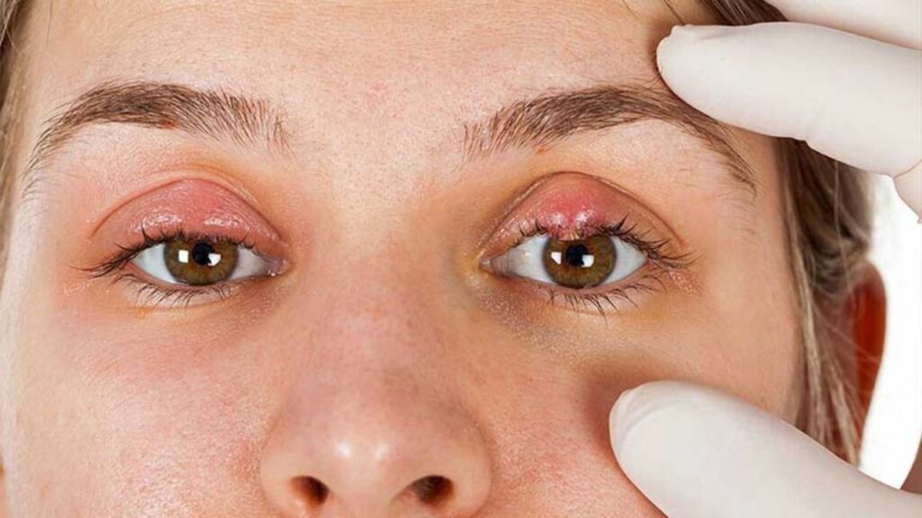 Điều trị lẹo mắt như thế nào? 