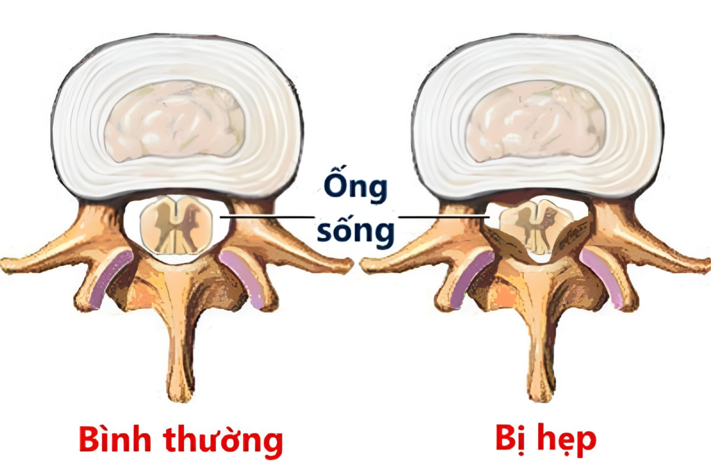 Hẹp ống sống là tình trạng ống sống bị thu hẹp lại về không gian 