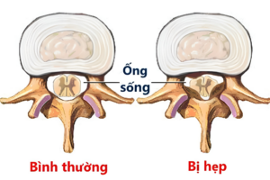 Hẹp ống sống là tình trạng ống sống bị thu hẹp lại về không gian