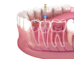 Quy trình lấy tủy răng và những thông tin cần biết