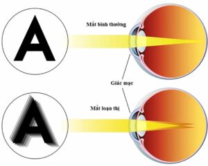 Mắt bị loạn thị