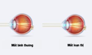 Loạn thị là gì? Nguyên nhân, triệu chứng & cách điều trị