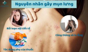 Nguyên nhân gây mụn lưng