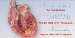 Nhịp tim nhanh là gì?