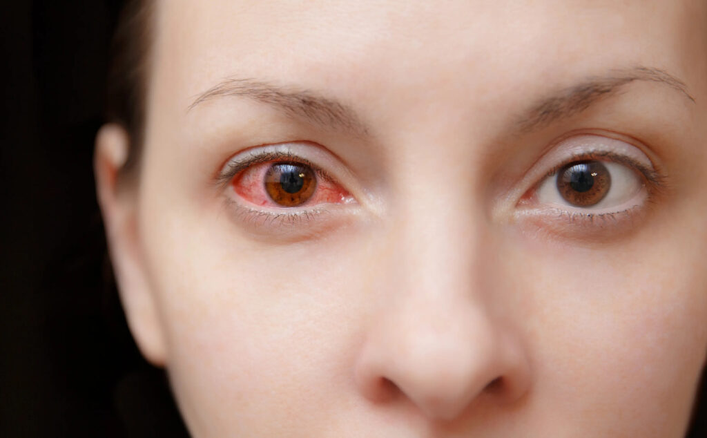 Tình trạng đau nhức mắt có thể do nhiều nguyên nhân gây ra 